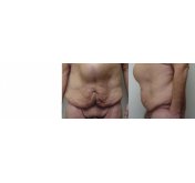 Hernia Repair And Abdominoplasty Before