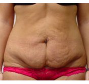 Abdominoplasty