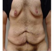 Male Breast Reduction Before Weight Loss