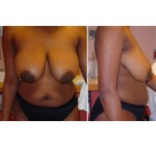 Breast Lift