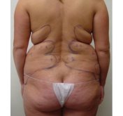 Liposuction